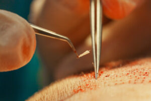 atraia mais clientes para sua clínica de transplante capilar